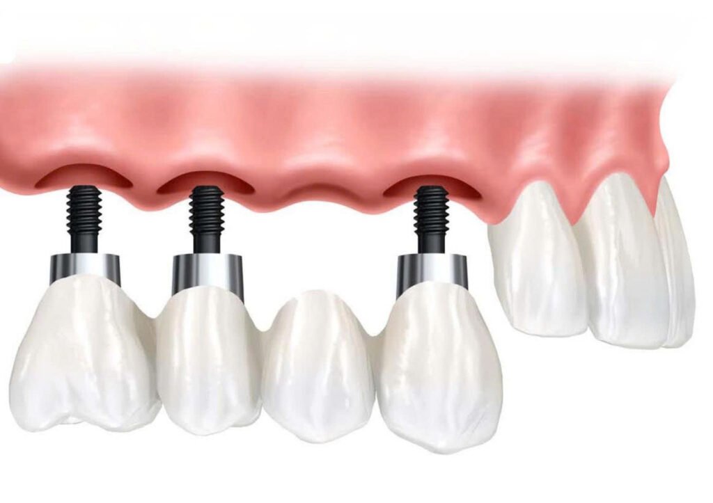 Mất 4 Răng Liên Tiếp: Hậu Quả Khôn Lường và 3 Giải Pháp Phục Hồi Tốt Nhất Hiện Nay