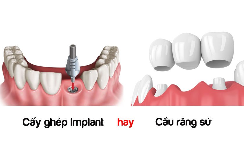 Trồng Răng Giả Cố Định: Giải Pháp Phục Hồi Răng Mất Toàn Diện Nhất