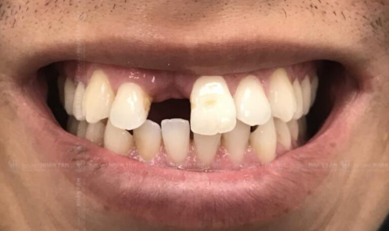 Mất răng cửa có sao không? Phương pháp nào tốt nhất phục răng cửa?