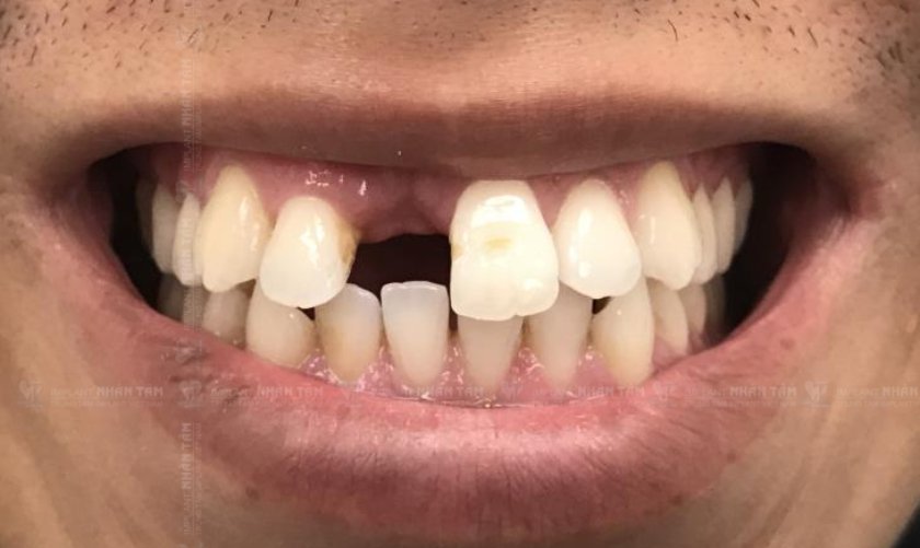 Mất răng cửa có sao không? Phương pháp nào tốt nhất phục răng cửa?