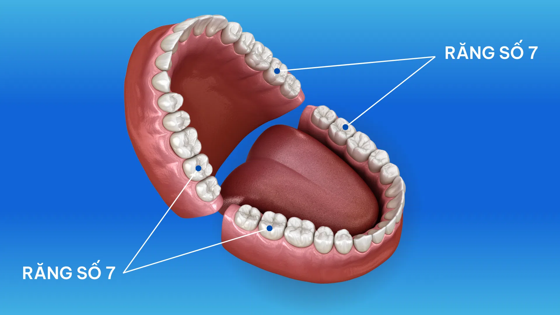 Mất răng số 7 hàm dưới: Nguyên nhân, hậu quả & giải pháp phục hồi tối ưu