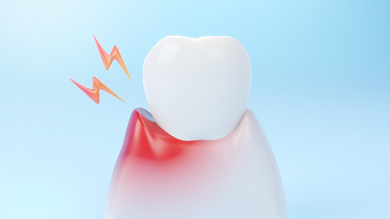 Mất răng số 5: Nguyên nhân, hậu quả và giải pháp phục hình hiệu quả
