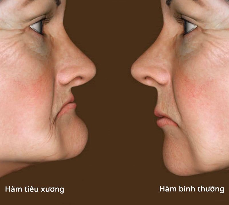 Mất răng bao lâu thì bị tiêu xương hàm? Nguyên nhân, dấu hiệu và cách phòng ngừa hiệu quả