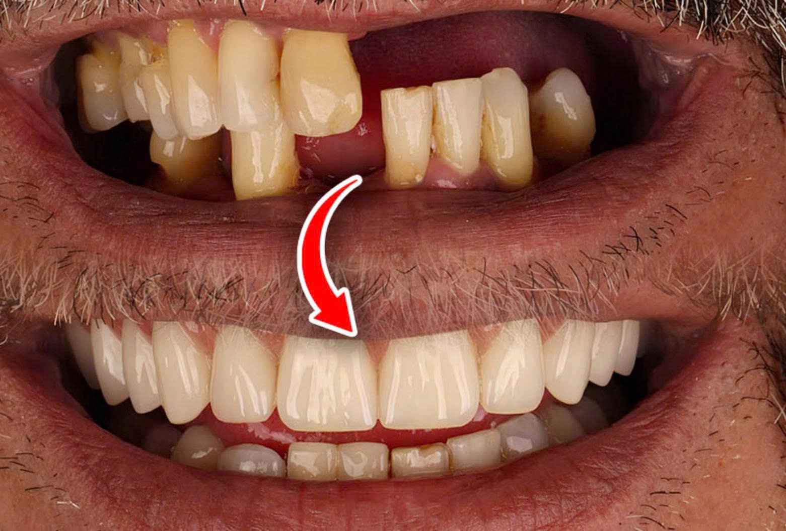 Mất răng có bọc sứ được không? Giải pháp thay thế hiệu quả nhất