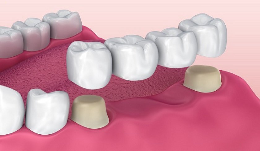 Mất 4 Răng Liên Tiếp: Hậu Quả Khôn Lường và 3 Giải Pháp Phục Hồi Tốt Nhất Hiện Nay