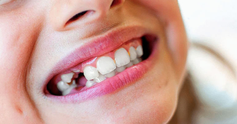 Hậu quả mất răng lâu ngày nguy hiểm như thế nào?