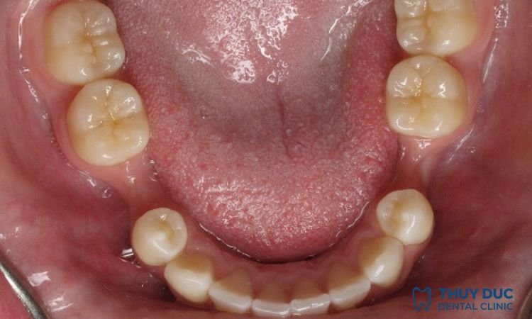 Mất răng bao lâu thì bị tiêu xương hàm? Nguyên nhân, dấu hiệu và cách phòng ngừa hiệu quả