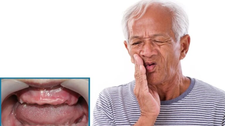 Mất răng toàn hàm: Nguyên nhân, hậu quả và giải pháp phục hình hiệu quả