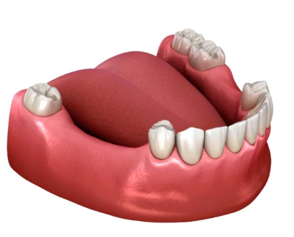 Mất 4 Răng Liên Tiếp: Hậu Quả Khôn Lường và 3 Giải Pháp Phục Hồi Tốt Nhất Hiện Nay