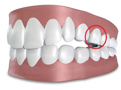 Mất răng số 5: Nguyên nhân, hậu quả và giải pháp phục hình hiệu quả