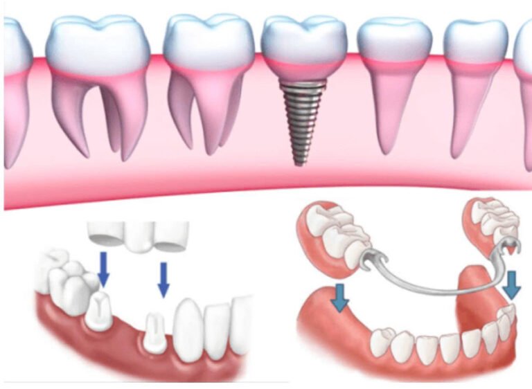 Tất tần tật về các phương pháp trồng răng giả phổ biến, hiệu quả nhất hiện nay