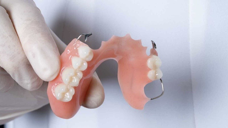 Trồng Răng Giả Hàm Tháo Lắp: Giải Pháp Tiết Kiệm Cho Người Mất Răng