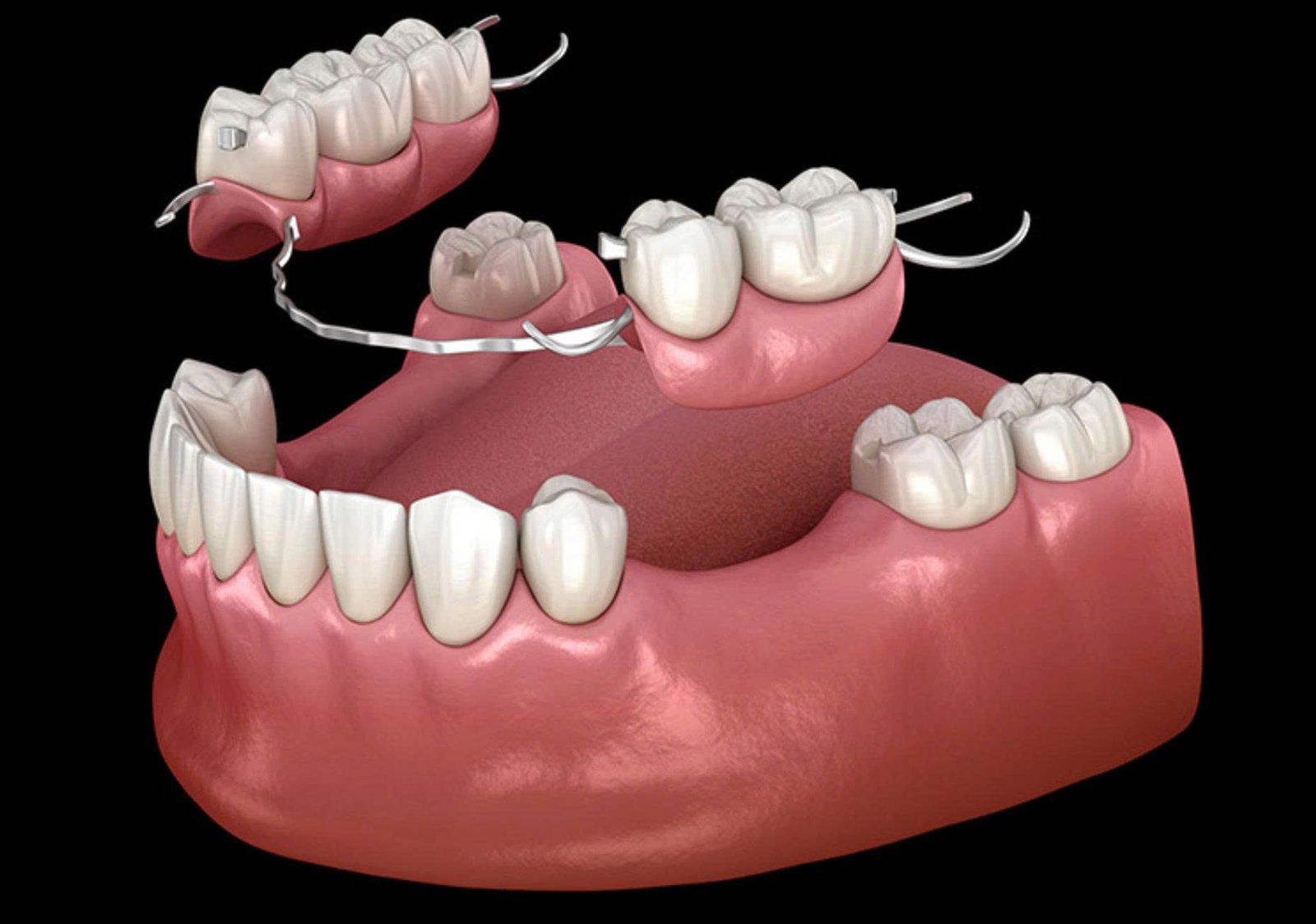 Trồng Răng Giả Hàm Tháo Lắp: Giải Pháp Tiết Kiệm Cho Người Mất Răng