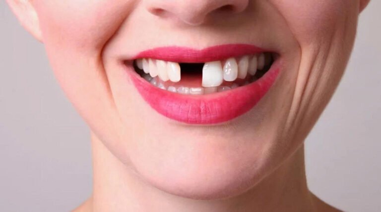 Trồng Răng Giả: Tất Tần Tật Các Giải Pháp Giúp Khôi Phục Nụ Cười Tự Tin