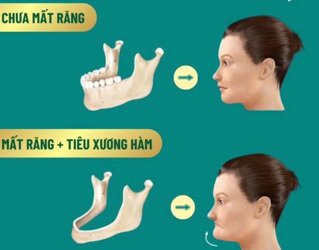 Trồng Răng Giả: Tất Tần Tật Các Giải Pháp Giúp Khôi Phục Nụ Cười Tự Tin