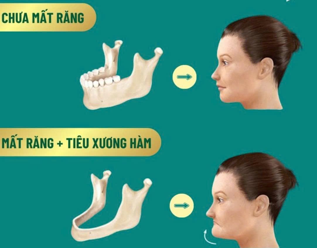 Trồng Răng Giả Nguyên Hàm: Tìm Lại Nụ Cười & Khả Năng Ăn Nhai Toàn Diện