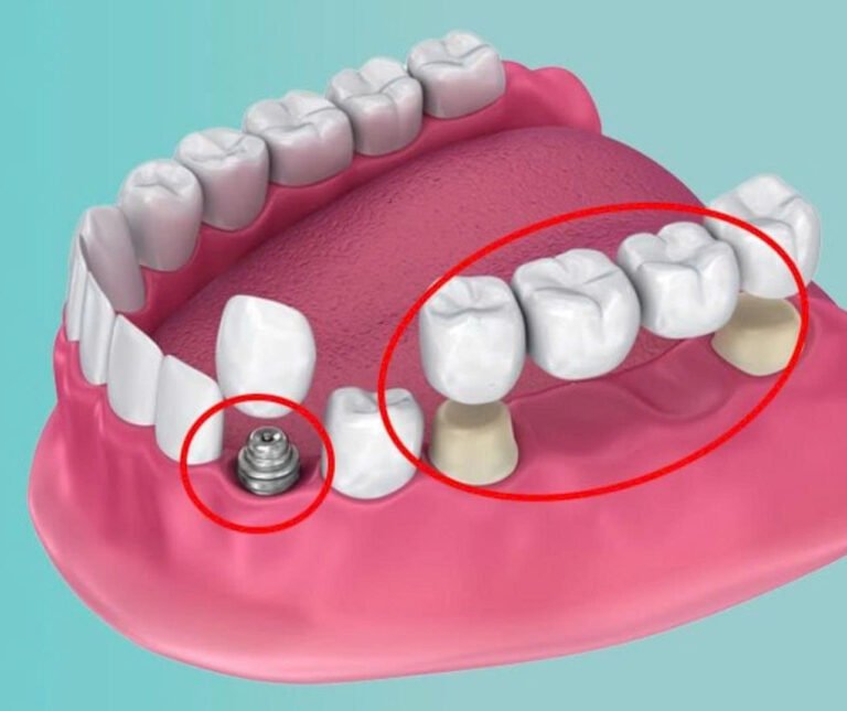 Trồng Răng Giả Cố Định: Giải Pháp Phục Hồi Răng Mất Toàn Diện Nhất