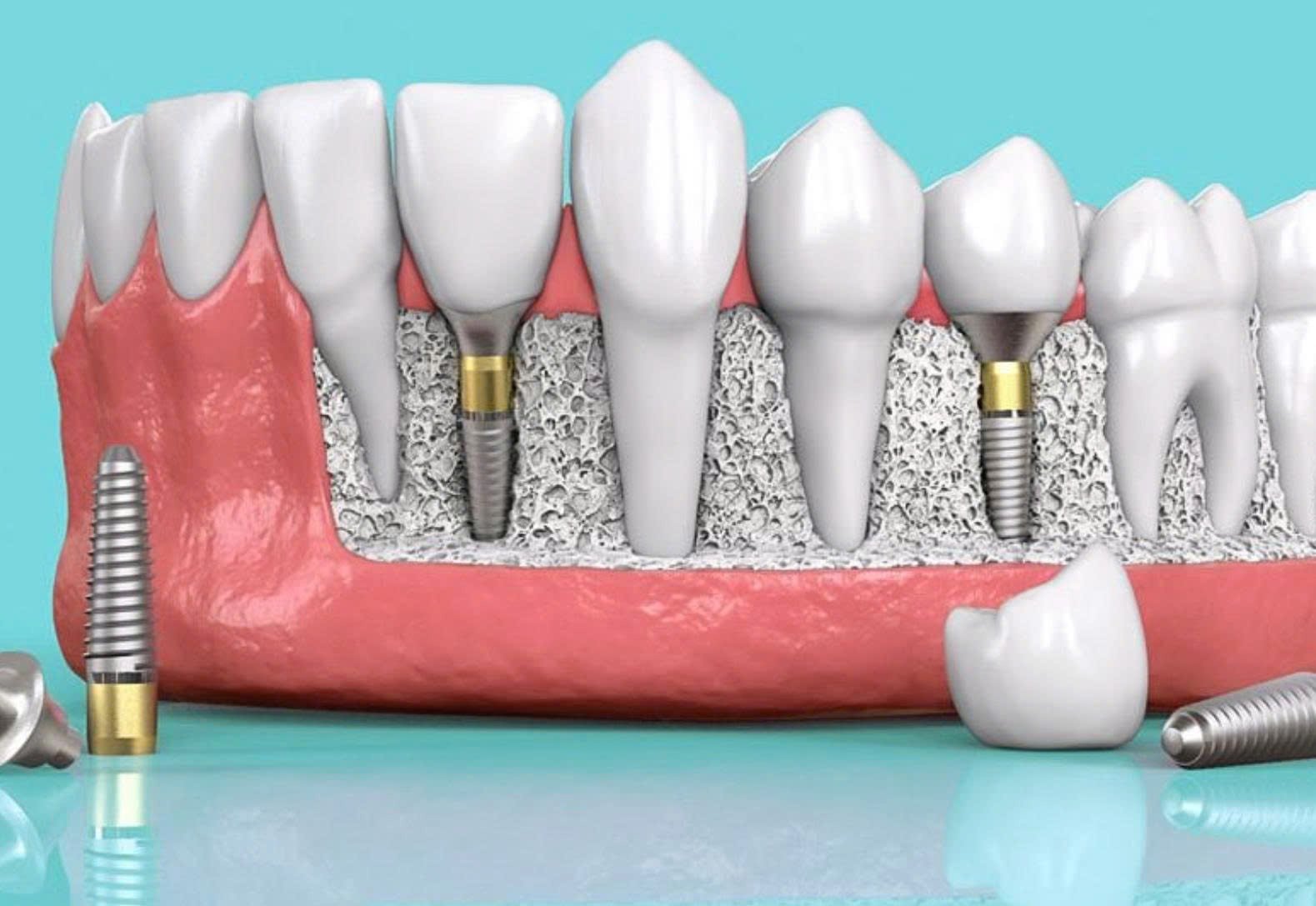 Trồng Răng Giả Cố Định: Giải Pháp Phục Hồi Răng Mất Toàn Diện Nhất