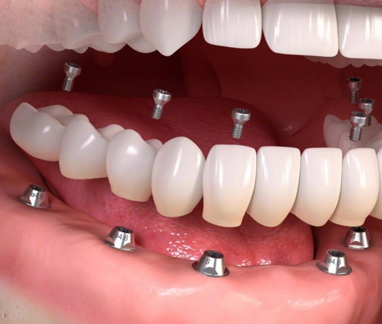 Trồng răng giả vĩnh viễn là gì?