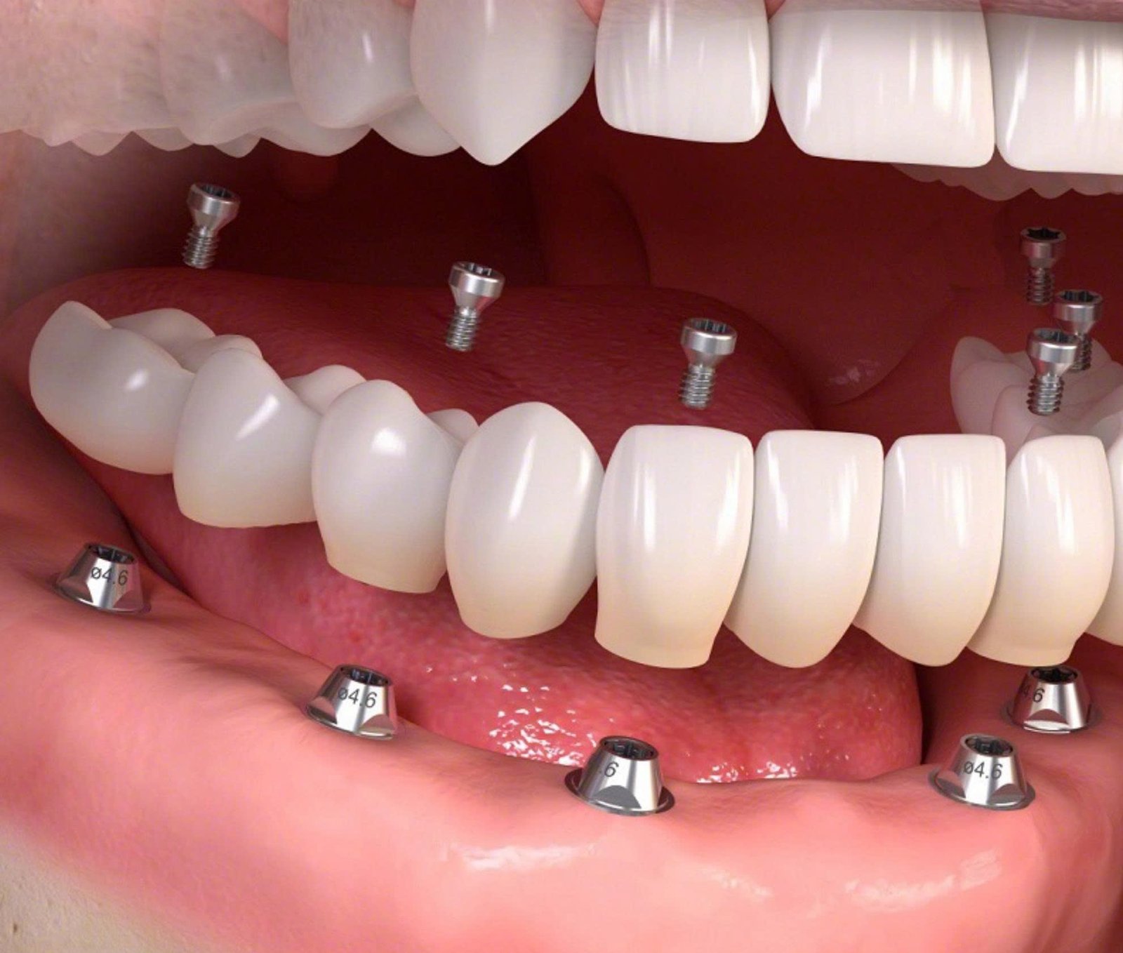 Trồng răng giả vĩnh viễn là gì?