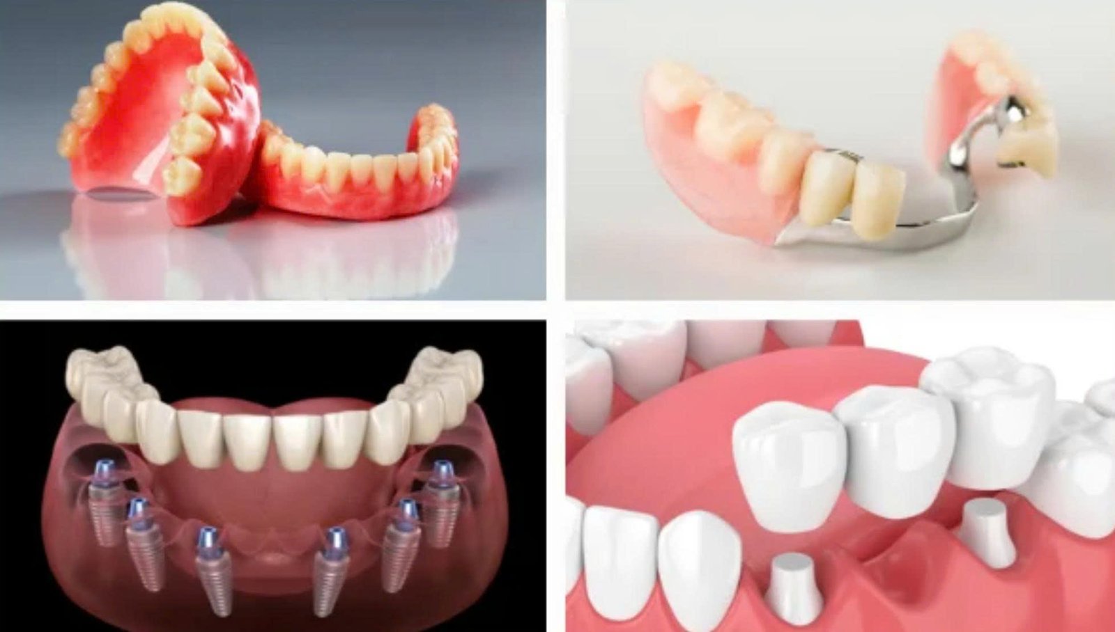 Trồng răng giả vĩnh viễn là gì?