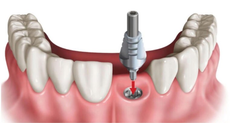 Trồng răng giả vĩnh viễn là gì?