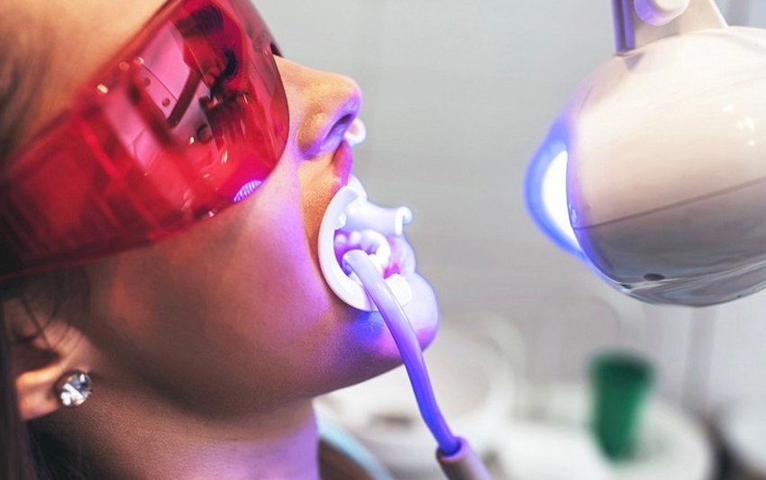 Teeth Whitening at Nha Khoa 3C: Achieve 3 Shades Lighter in Just 60 Minutes