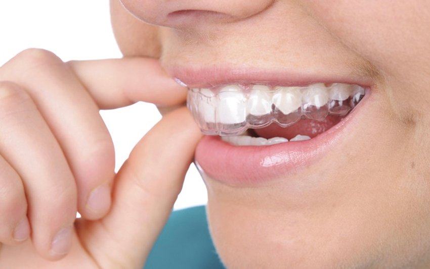 Tẩy trắng răng tại Nha khoa 3C: Răng trắng sáng 3 tone chỉ sau 60 phút