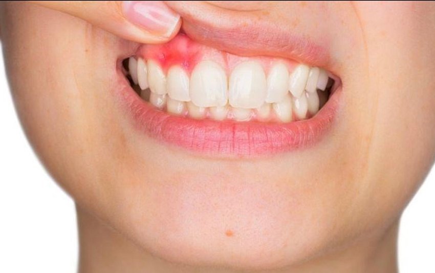 Điều trị viêm nha chu – Giải pháp giúp bảo vệ sức khỏe răng hàm hiệu quả