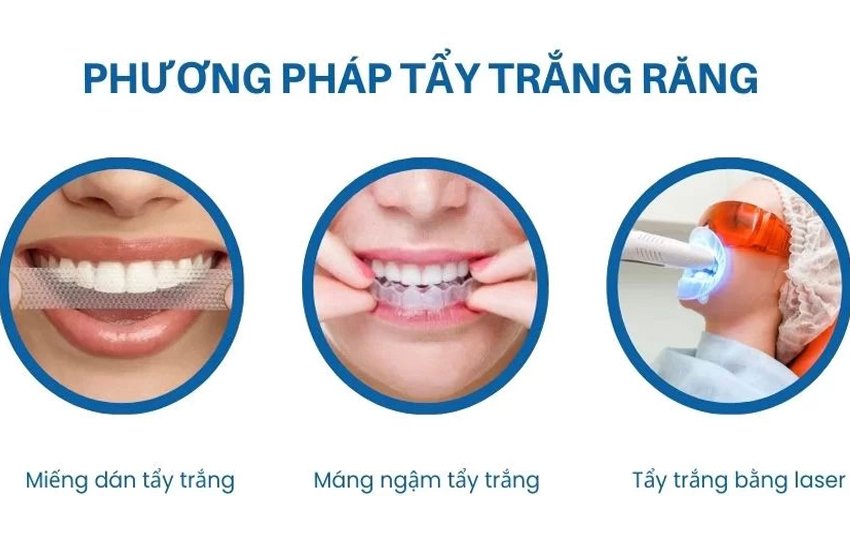 Tẩy trắng răng tại Nha khoa 3C: Răng trắng sáng 3 tone chỉ sau 60 phút