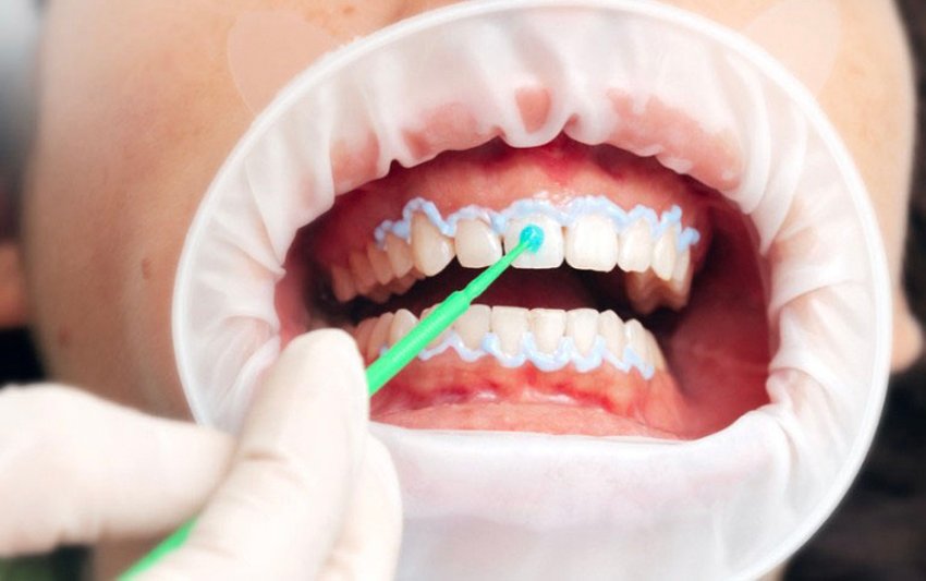 Tẩy trắng răng tại Nha khoa 3C: Răng trắng sáng 3 tone chỉ sau 60 phút