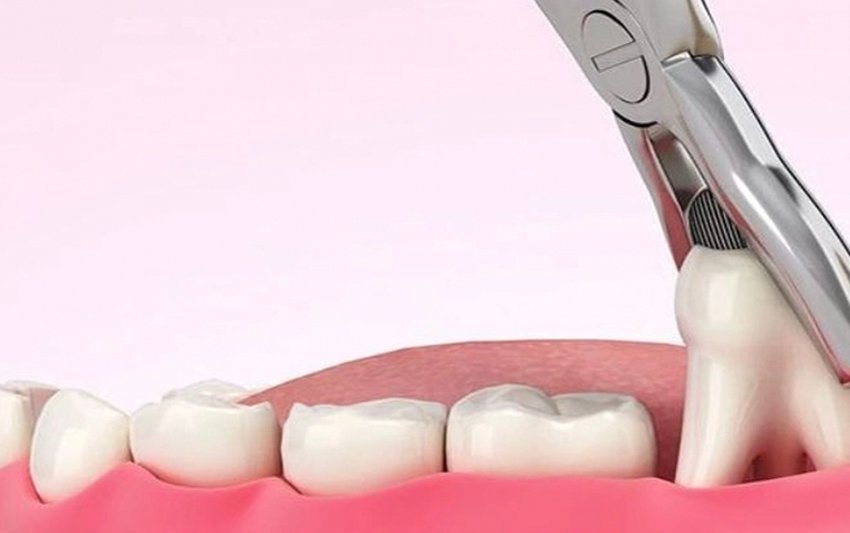 Nhổ răng khôn mọc ngầm an toàn, nhanh chóng, ít sưng đau