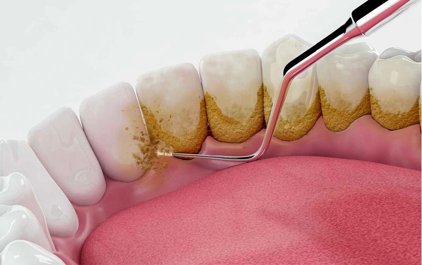 Cạo vôi răng định kỳ 3 – 6 tháng: Giải pháp giúp răng sạch – lợi khỏe