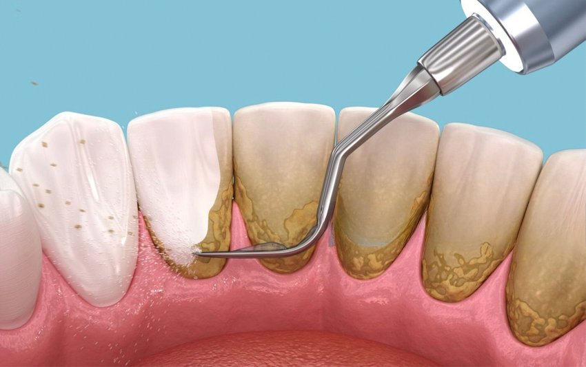 Cạo vôi răng định kỳ 3 – 6 tháng: Giải pháp giúp răng sạch – lợi khỏe