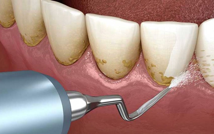 Cạo vôi răng định kỳ 3 – 6 tháng: Giải pháp giúp răng sạch – lợi khỏe