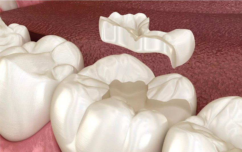 Hàn trám răng – Giải pháp phục hình răng sứt, mẻ, vỡ nhanh chóng